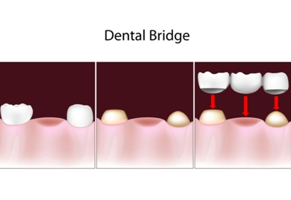 dental bridges in west edmonton