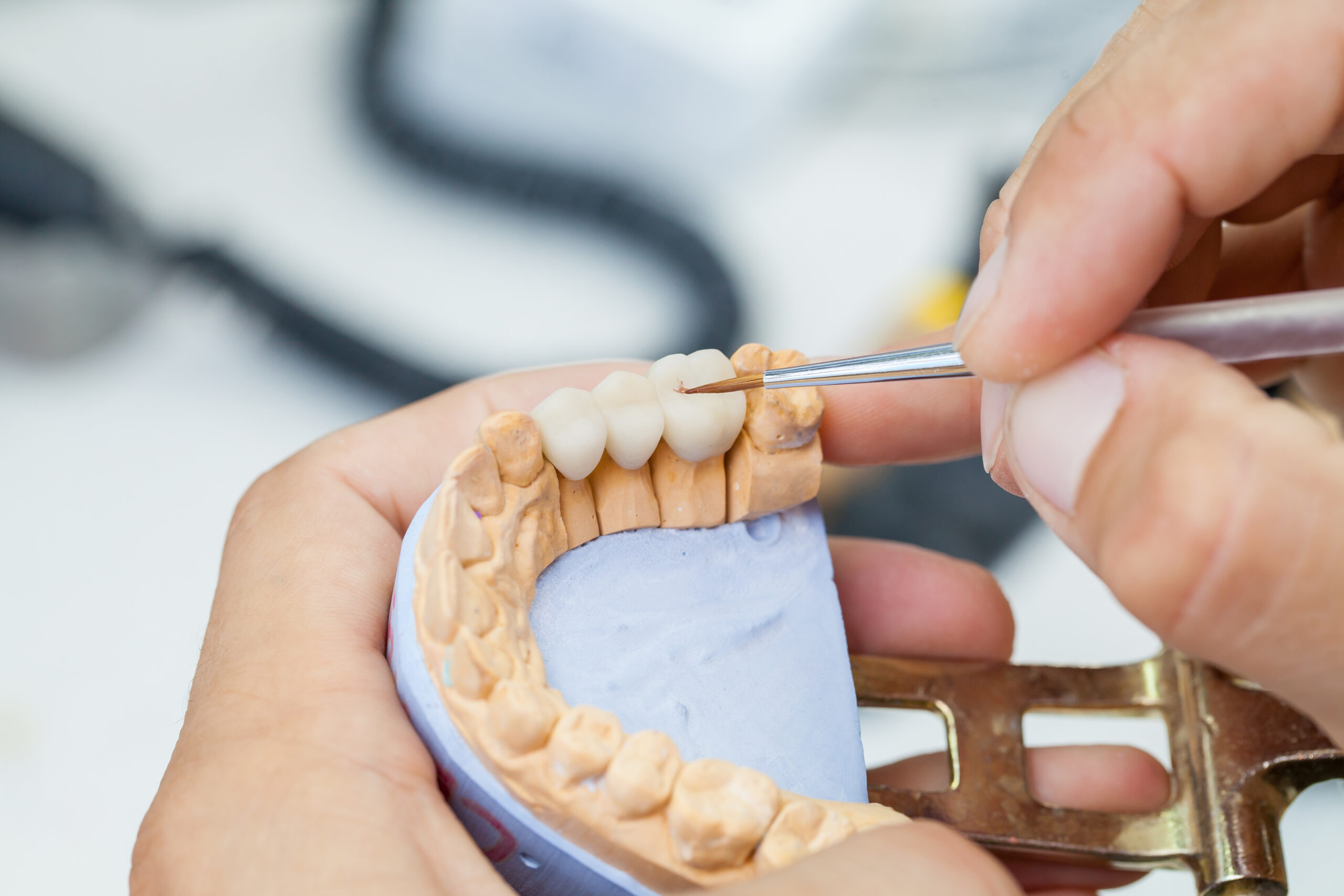 dental bridge aftercare and maintenance