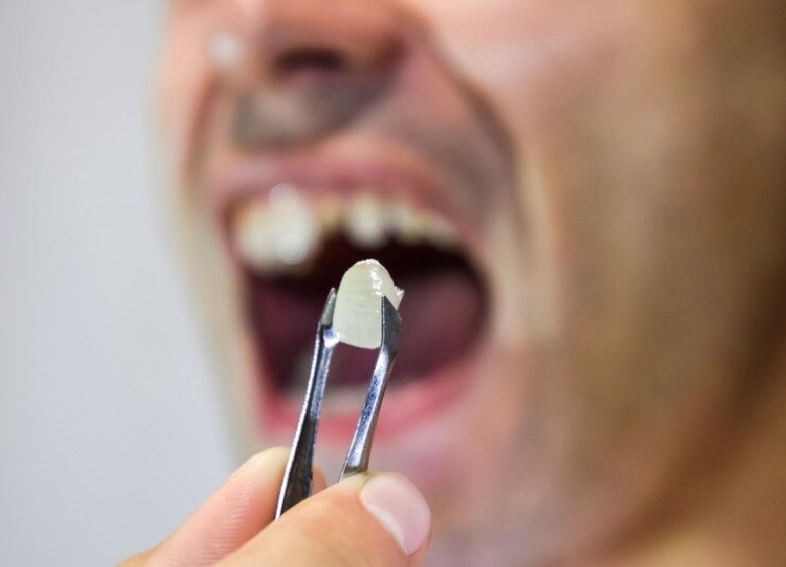 Common Reasons for Tooth Extractions and How to Prevent Them