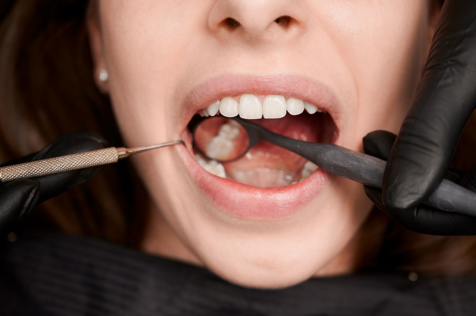 Tooth Extraction Procedure and Healing: A Patient-Friendly Guide
